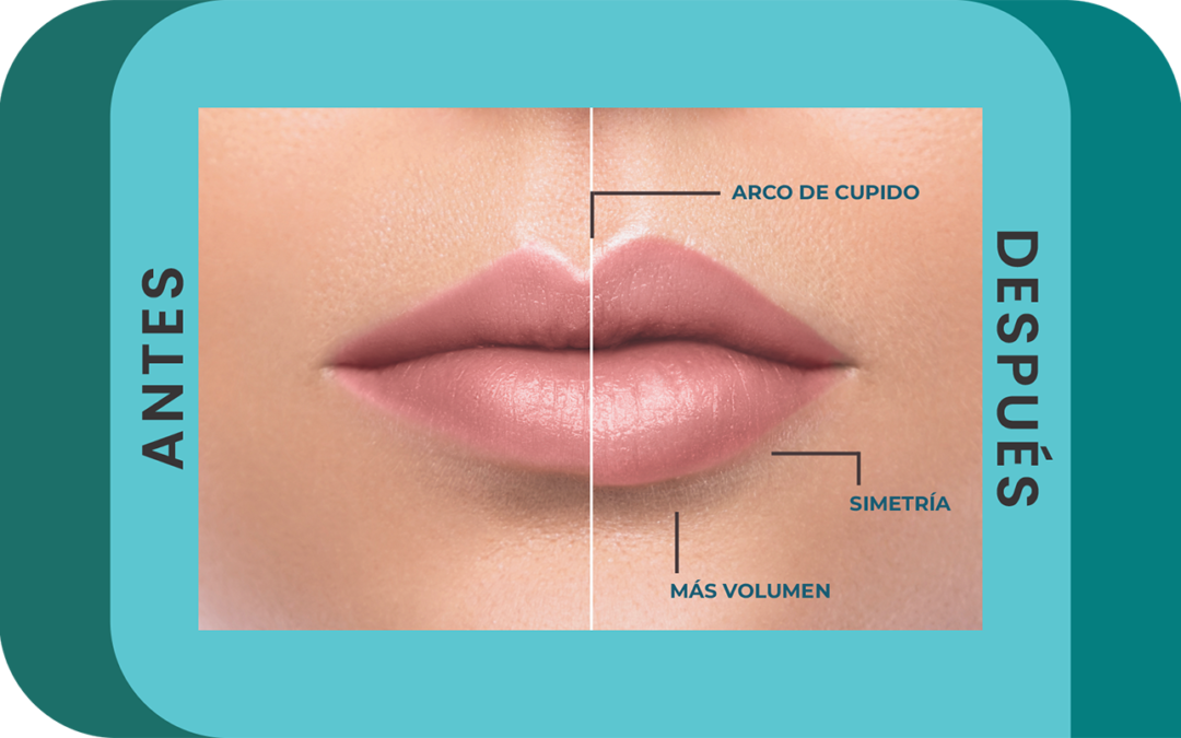 Aumento de labios con ácido hialurónico